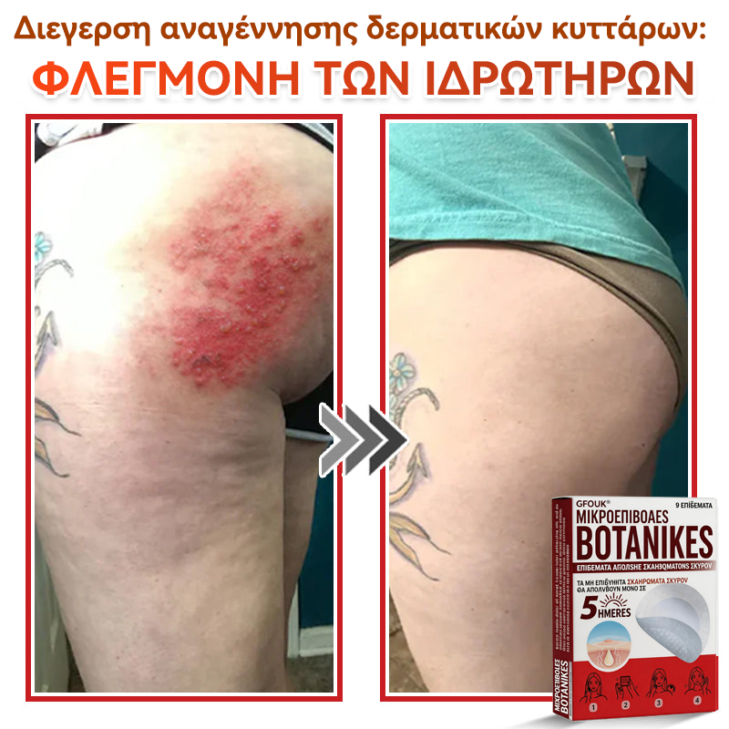 🗽✅ GFOUK® MicroNeedle Botanic επίθεμα για την αφαίρεση δερματικών θηλωμάτων