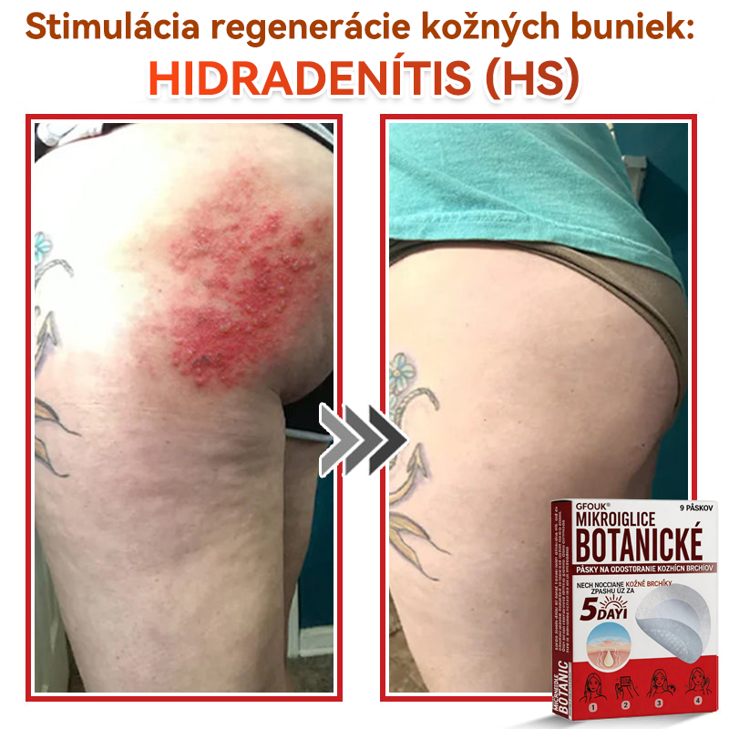 🔥🔥✅GFOUK® MicroNeedle botanic náplasť na odstránenie kožných výrastkov Vyrobené