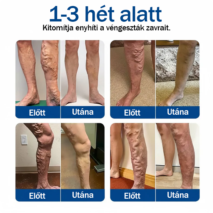 👨‍⚕️✅ TAILEDEN® VeinEase mikronáplasť s mikroihličkami ⚡ Okamžitá úľava, dlhodobé výsledky