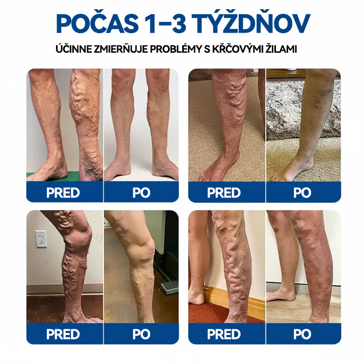 👨‍⚕️✅ TAILEDEN® VeinEase mikronáplasť s mikroihličkami ⚡ Okamžitá úľava, dlhodobé výsledky