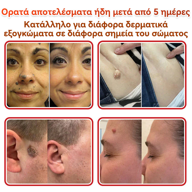 🗽✅ GFOUK® MicroNeedle Botanic επίθεμα για την αφαίρεση δερματικών θηλωμάτων