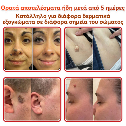 🗽✅ GFOUK® MicroNeedle Botanic επίθεμα για την αφαίρεση δερματικών θηλωμάτων