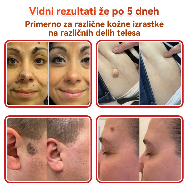 🗽✅GFOUK®Botanični obliž z mikroiglami za odstranjevanje kožnih izrastkov