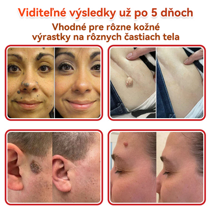 🔥🔥✅GFOUK® MicroNeedle botanic náplasť na odstránenie kožných výrastkov Vyrobené