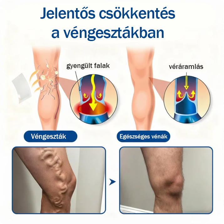 👨‍⚕️✅ TAILEDEN® VeinEase mikronáplasť s mikroihličkami ⚡ Okamžitá úľava, dlhodobé výsledky