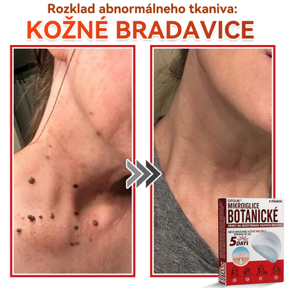 🔥🔥✅GFOUK® MicroNeedle botanic náplasť na odstránenie kožných výrastkov Vyrobené