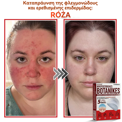 🗽✅ GFOUK® MicroNeedle Botanic επίθεμα για την αφαίρεση δερματικών θηλωμάτων