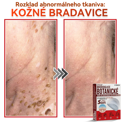 🔥🔥✅GFOUK® MicroNeedle botanic náplasť na odstránenie kožných výrastkov Vyrobené