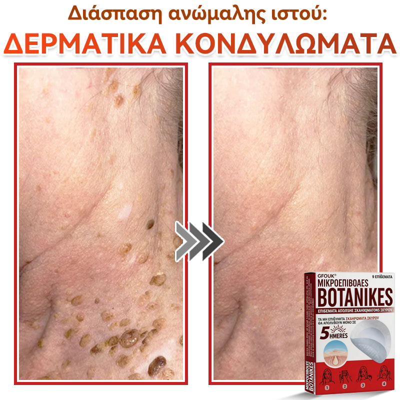 🗽✅ GFOUK® MicroNeedle Botanic επίθεμα για την αφαίρεση δερματικών θηλωμάτων